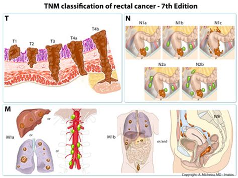 Colon Cancer: Cancer Colon Tnm