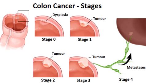 Colon Cancer   Causes, Diagnosis and Treatment