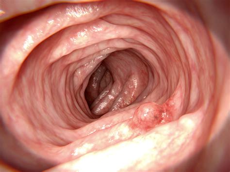 Colon Cancer: Find It Early – Health Essentials from ...