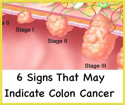Colon Cancer | Hiatus hernia / diverticulitis | Pinterest ...