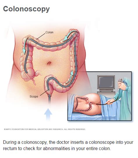 Colon Cancer Screening: Weighing The Options   South ...