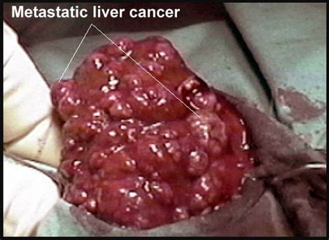 Colon Cancer: Stage 4 Colon Cancer Spread To Liver