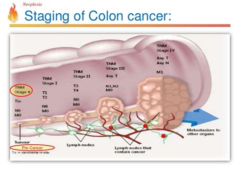 Colon Cancer Stages   Bing images