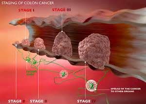 Colon Cancer Stages | Health Warnings