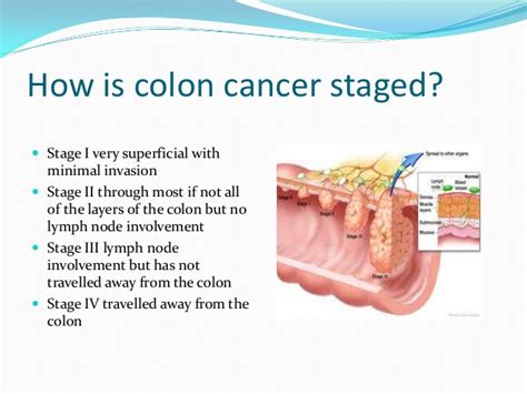Colon Cancer Stages – applecool.info