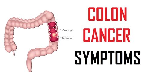 Colon Cancer Symptoms – craftbrewswag.info