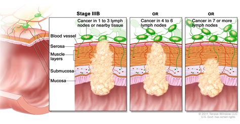 Colon Cancer Treatment  PDQ® —Health Professional Version ...