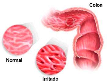 Colon irritable: causas, síntomas y tratamiento   eSalud.com
