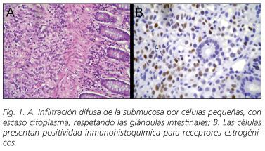 Colon metastasis of a lobular breast carcinoma