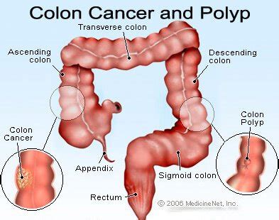 Colon Polyps: Symptoms, Types, Causes, Prevent & Pictures