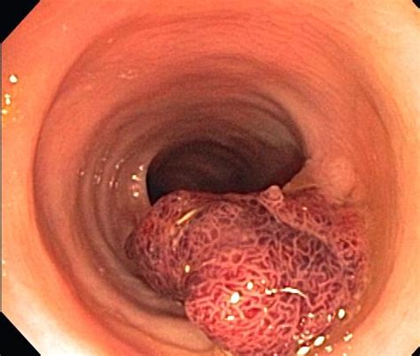 Colon Polyps: Which Ones Are Riskiest for You? – Health ...