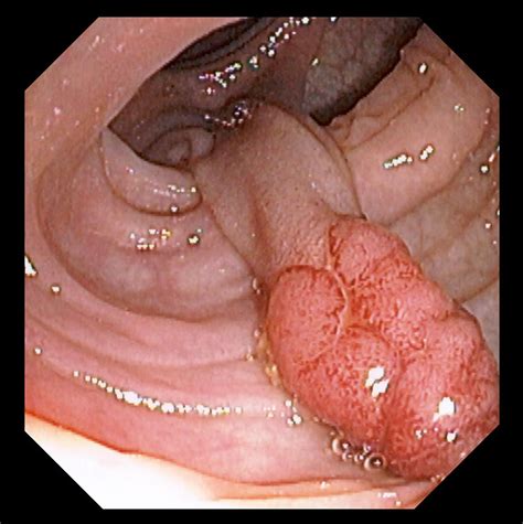 Colonic Polyp Photograph by David M. Martin, Md
