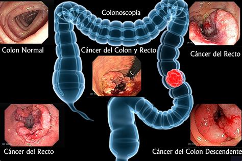 Colonoscopy   Notes on Cyber Gastroenterology   murrasaca.com