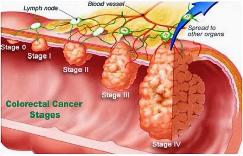 Colorectal Cancer, Causes, Symptoms And Signs | Health And ...