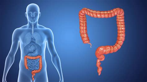 Colorectal Cancer  Colon Cancer and Rectal Cancer ...