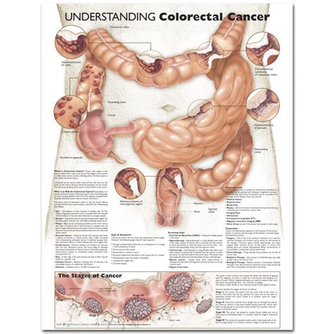 Colorectal Cancer Poster | Colon Cancer Anatomical Chart Co
