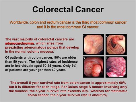 Colorectal Cancer.   ppt video online download