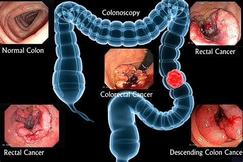 Colorectal cancer   Symptoms, Signs, and Prevention