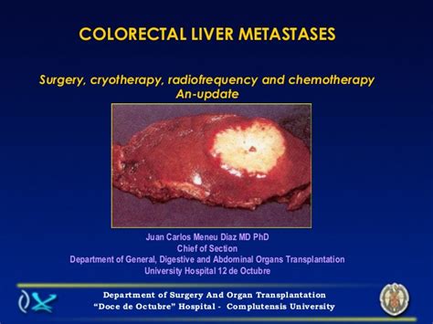 Colorectal liver metastases  Dr Juan Carlos Meneu Diaz ...
