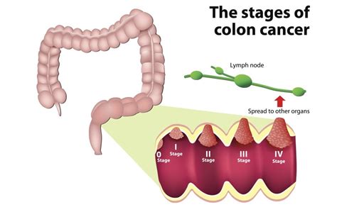 Colorectal Liver Metastasis and What That Means to You ...