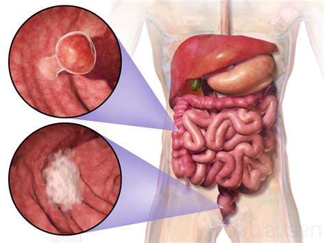 Colorectal Neoplasms; Colorectal Cancer