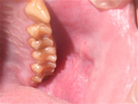 Colyer Institute – Salivary Duct Obstruction in a Bonobo