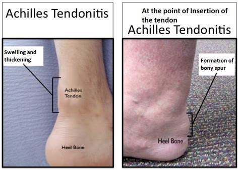 Common Injuries of the Achilles Tendon – Osteopathy Singapore