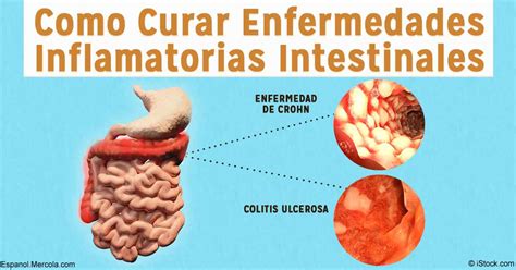 Cómo Curar Enfermedades Inflamatorias Intestinales