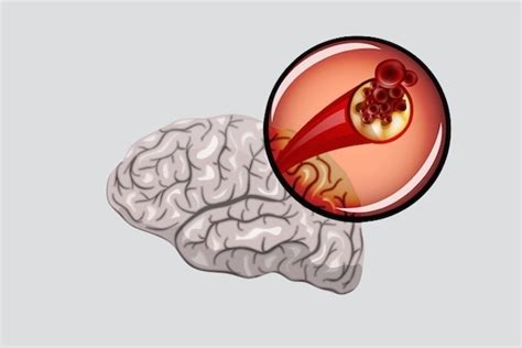 Como é feito o tratamento da isquemia cerebral Tua Saúde