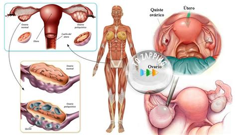 Cómo eliminar quistes de los ovarios con remedios naturales