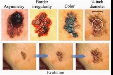 Cómo reconocer el cáncer de piel – Esto podría salvar tu ...