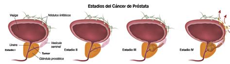 Cómo reconocer el cáncer de próstata