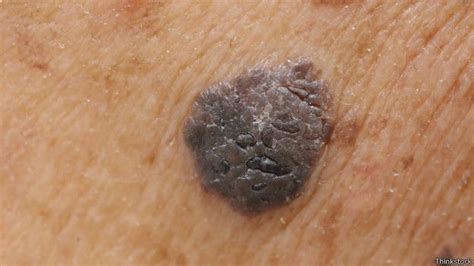 Cómo reconocer los síntomas del cáncer de piel