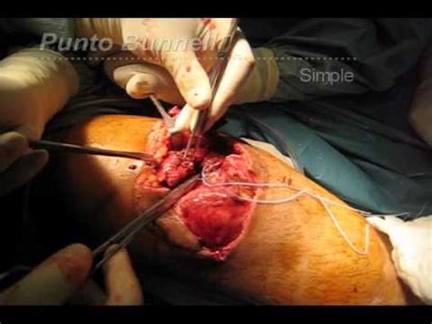 ¿Cómo se sutura un tendón al hueso? | Doovi