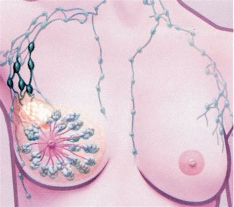 ¿Cómo son los síntomas del cáncer de mama?   CÁNCER DE MAMA