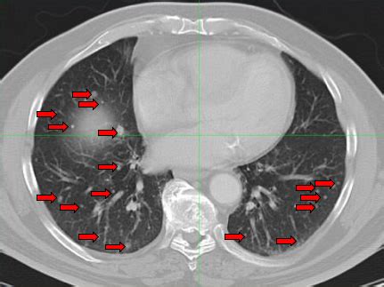 Complete remission of innumerable lung metastases from ...