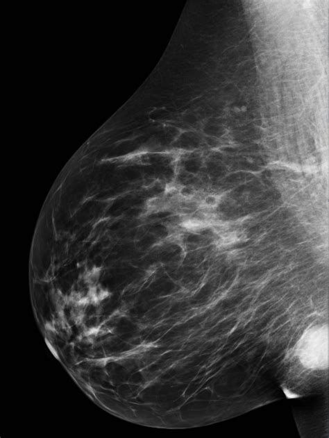 Complex cyst right breast | Image | Radiopaedia.org