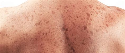 Concern at big rise in skin cancer cases   Luxembourg Herald