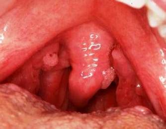 Conoce los síntomas del cáncer de “garganta”
