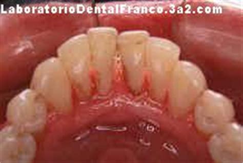 Contro de finfivitis periodontitis ¿En qué consiste el ...