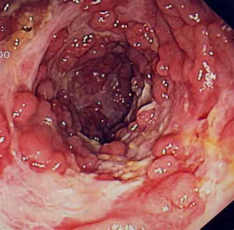 Crohn s Disease: Too Much, or Not Enough? | Medgadget