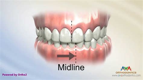 Crossbite on Back Teeth with Functional Shift ...