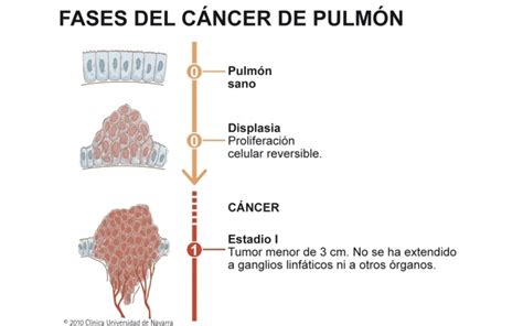 ¿Cuáles son las fases del #cancer de pulmón? | Neumología ...