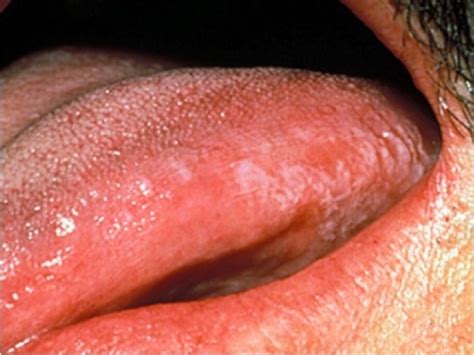 Cuáles son los primeros síntomas del cáncer de lengua   La ...