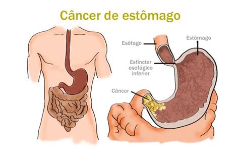 Cura Natural para el Cancer de Estomago | TUSALUDESVIDA