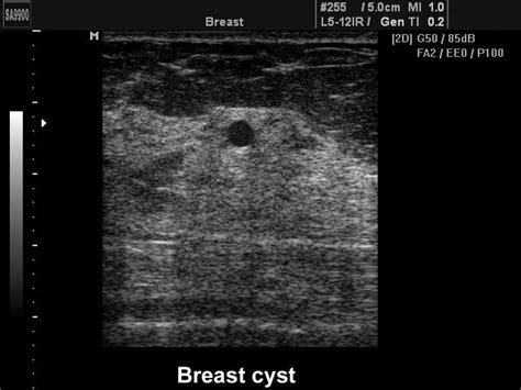 Cyst In Breast