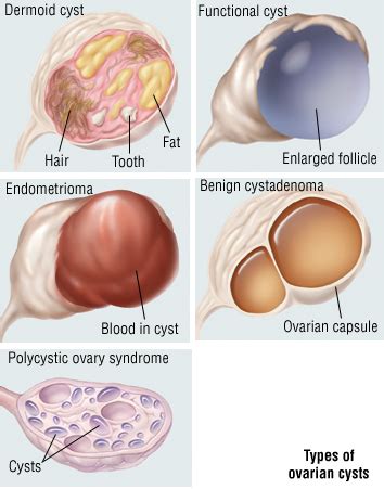 Cyst In Breast