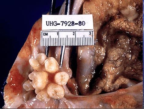 Cystic Teratoma   tumor with teeth and hair growing oin ...