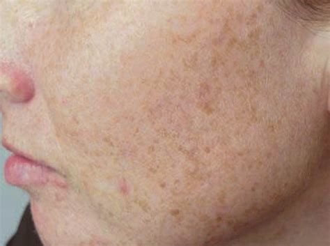 Dark Spots on Skin  10 Natural Remedies   Health Top Priority