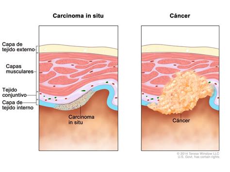 Definición de carcinoma in situ   Diccionario de cáncer ...